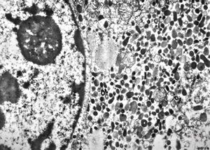 M, 62y. | pheochromocytoma M, 62y. | pheochromocytoma